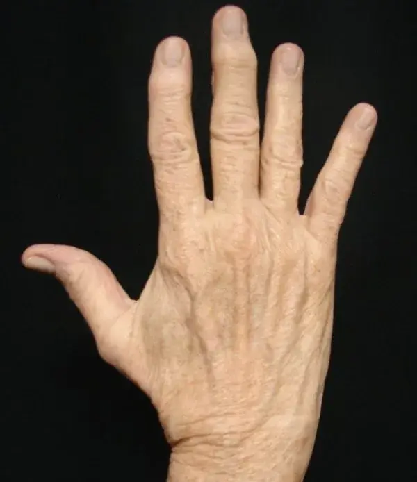 Fat Transfer before at Associates in Plastic Surgery in Virginia Beach, VA