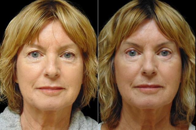 Blepharoplasty result at Associates in Plastic Surgery in Virginia Beach, VA