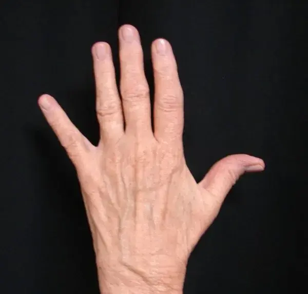 Fat Transfer before at Associates in Plastic Surgery in Virginia Beach, VA