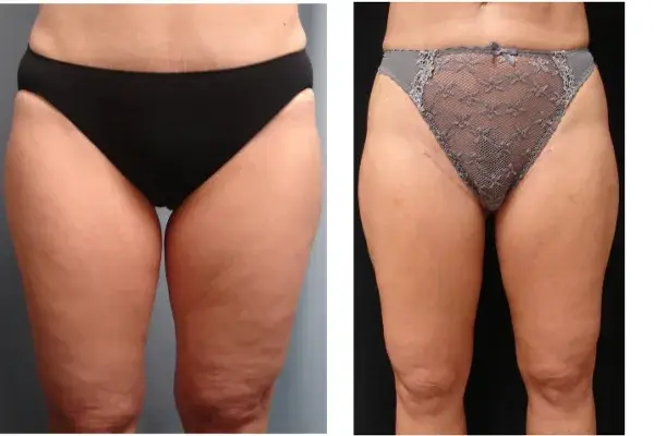 Arm Lift result at Associates in Plastic Surgery in Virginia Beach, VA