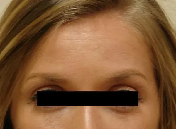 Botox before at Associates in Plastic Surgery in Virginia Beach, VA