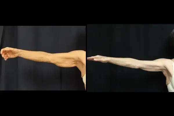 Associates in Plastic Surgery arm lift result — Virginia Beach, VA