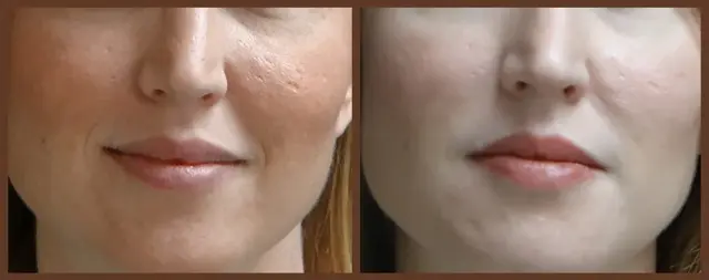 Juvederm result at Associates in Plastic Surgery in Virginia Beach, VA