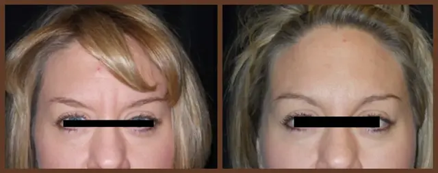 Botox result at Associates in Plastic Surgery in Virginia Beach, VA