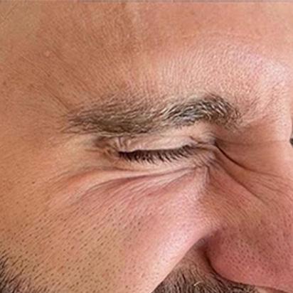 Spa Trouvé botox after — St. George, UT