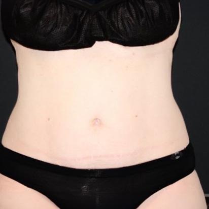 CoolSculpting after at Spa Trouve in St. George, UT