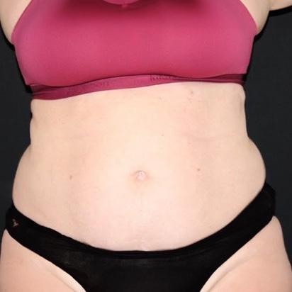 CoolSculpting before at Spa Trouve in St. George, UT