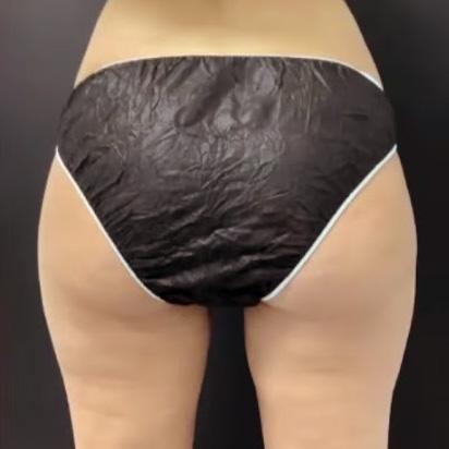 Spa Trouve body contouring after — St. George, UT