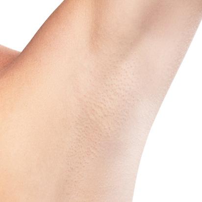 Spa Trouve hair restoration after — St. George, UT