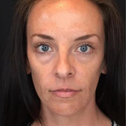 Juvederm before at Spa Trouvé in St. George, UT