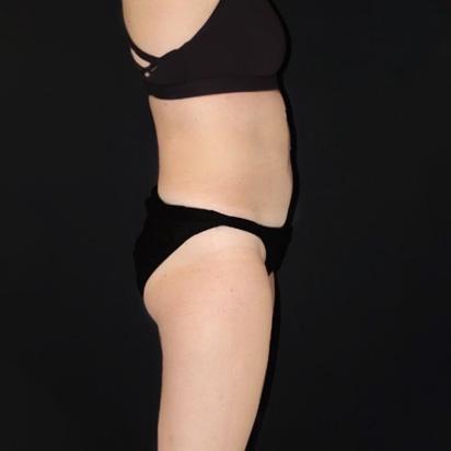 Spa Trouve coolsculpting after — St. George, UT