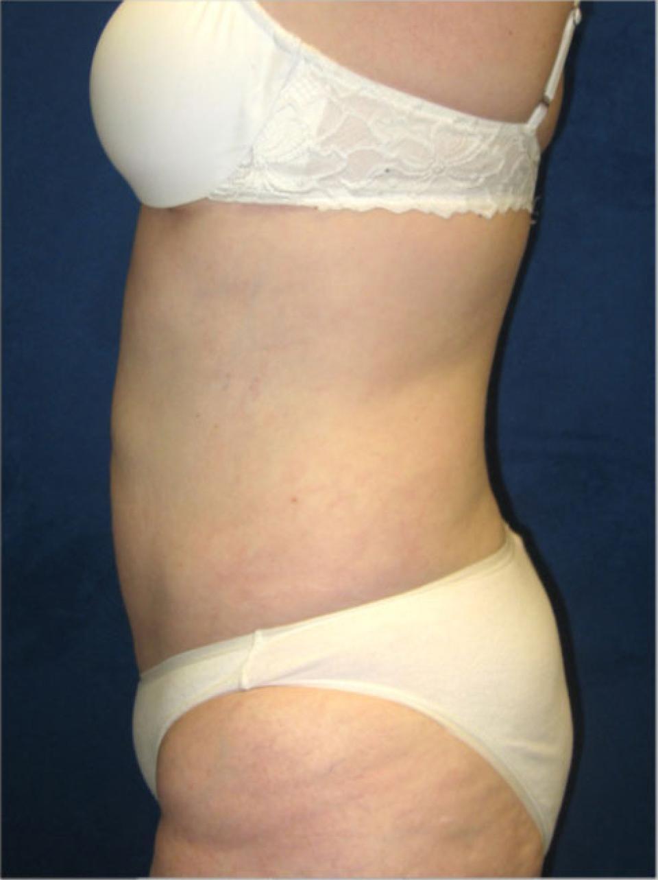 Ksenija Belsley, MD liposuction after — New York, NY