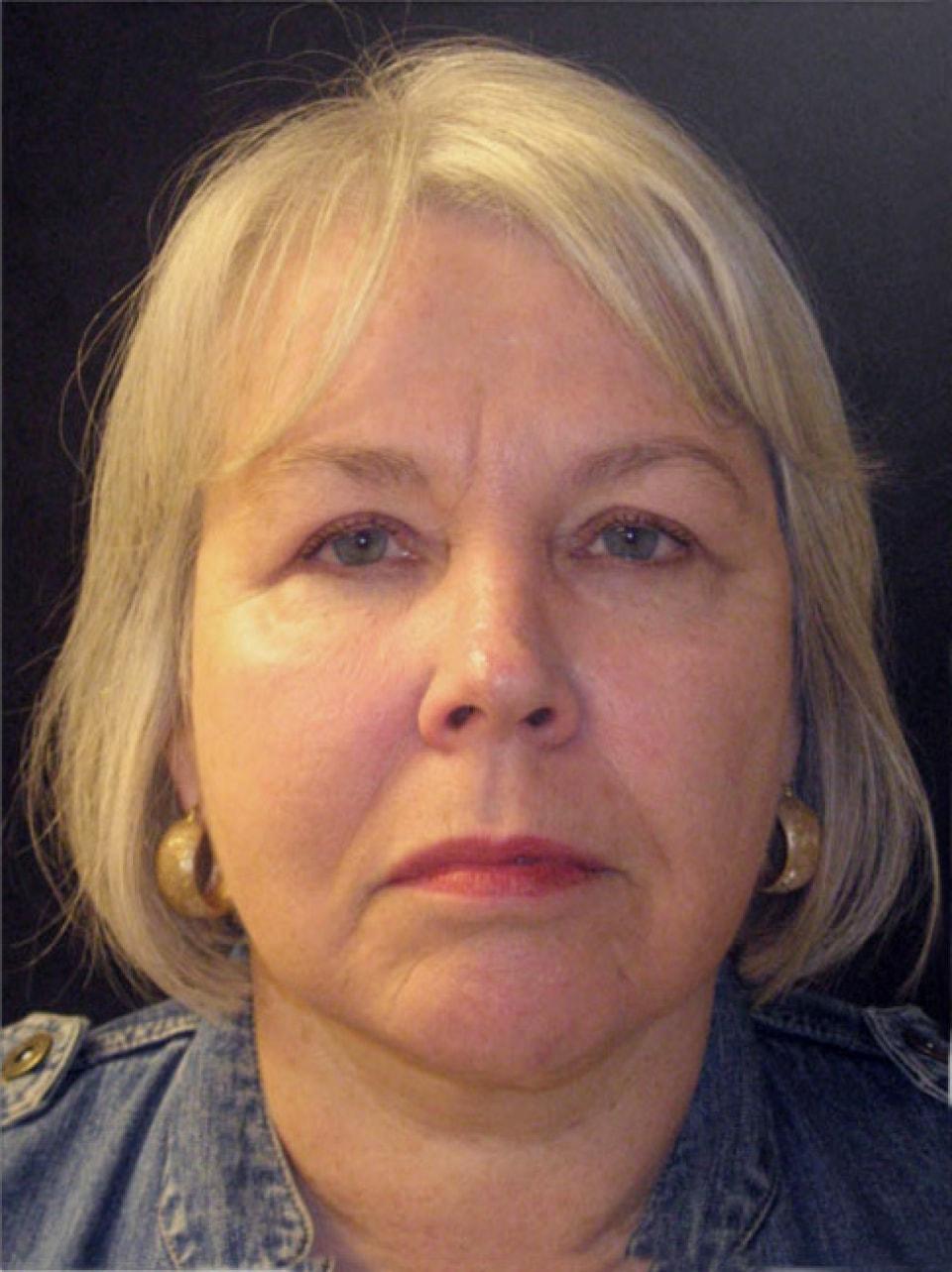 Ksenija Belsley, MD facelift after — New York, NY