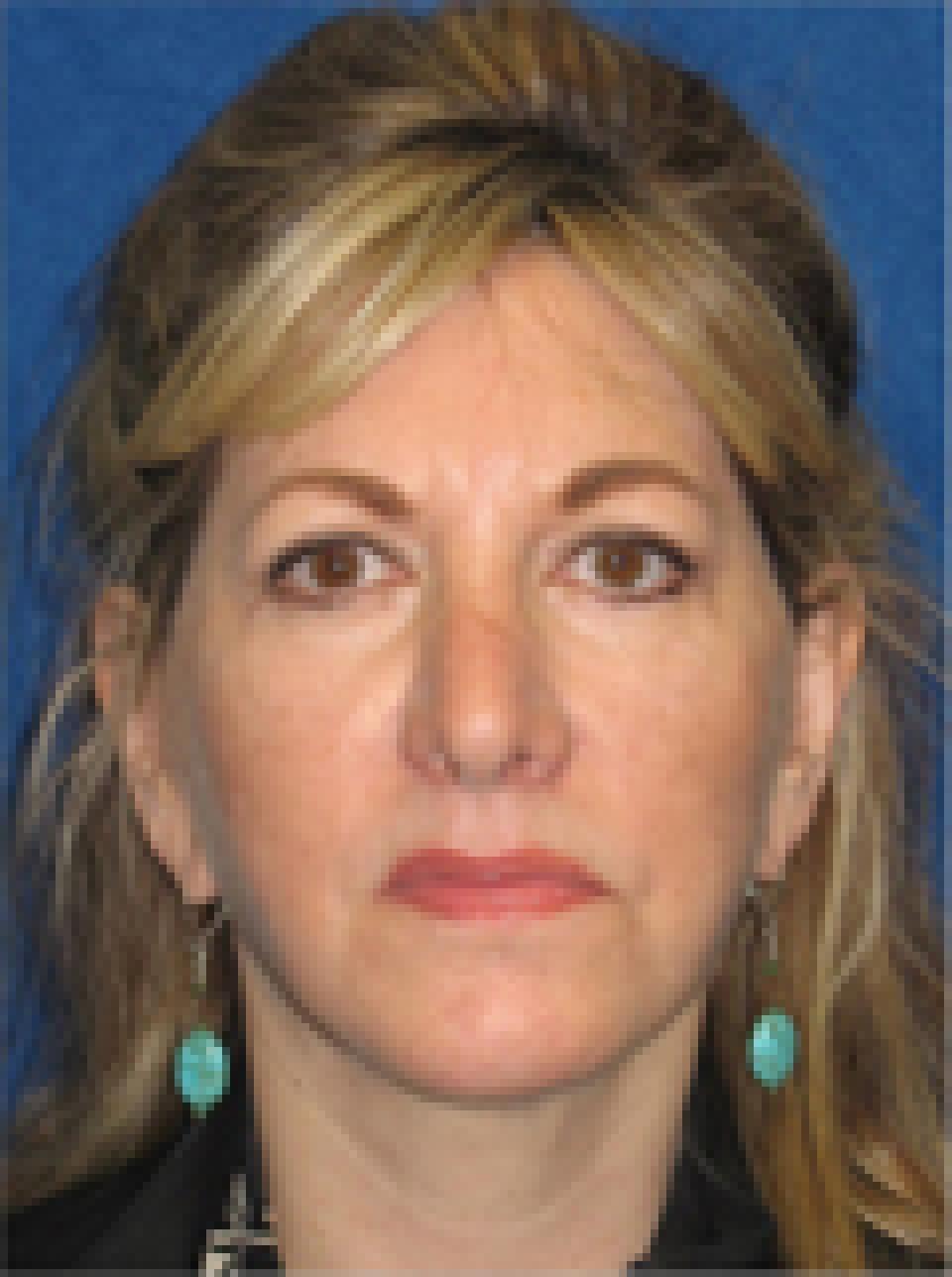 Ksenija Belsley, MD eyelid lift after — New York, NY