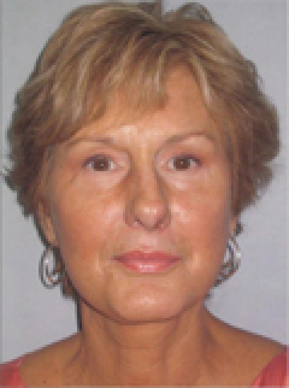 Ksenija Belsley, MD eyelid lift after — New York, NY