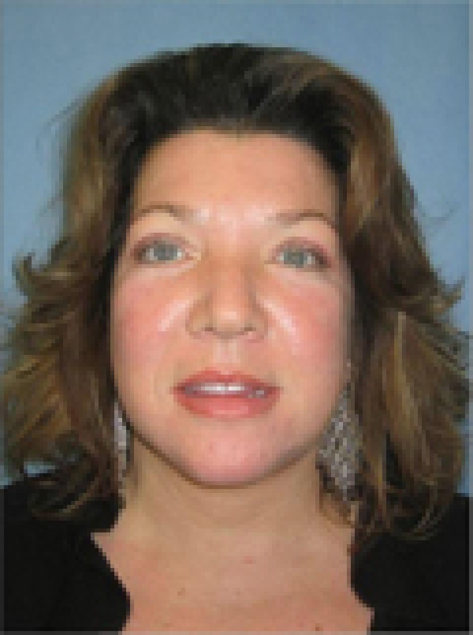 Ksenija Belsley, MD eyelid lift after — New York, NY