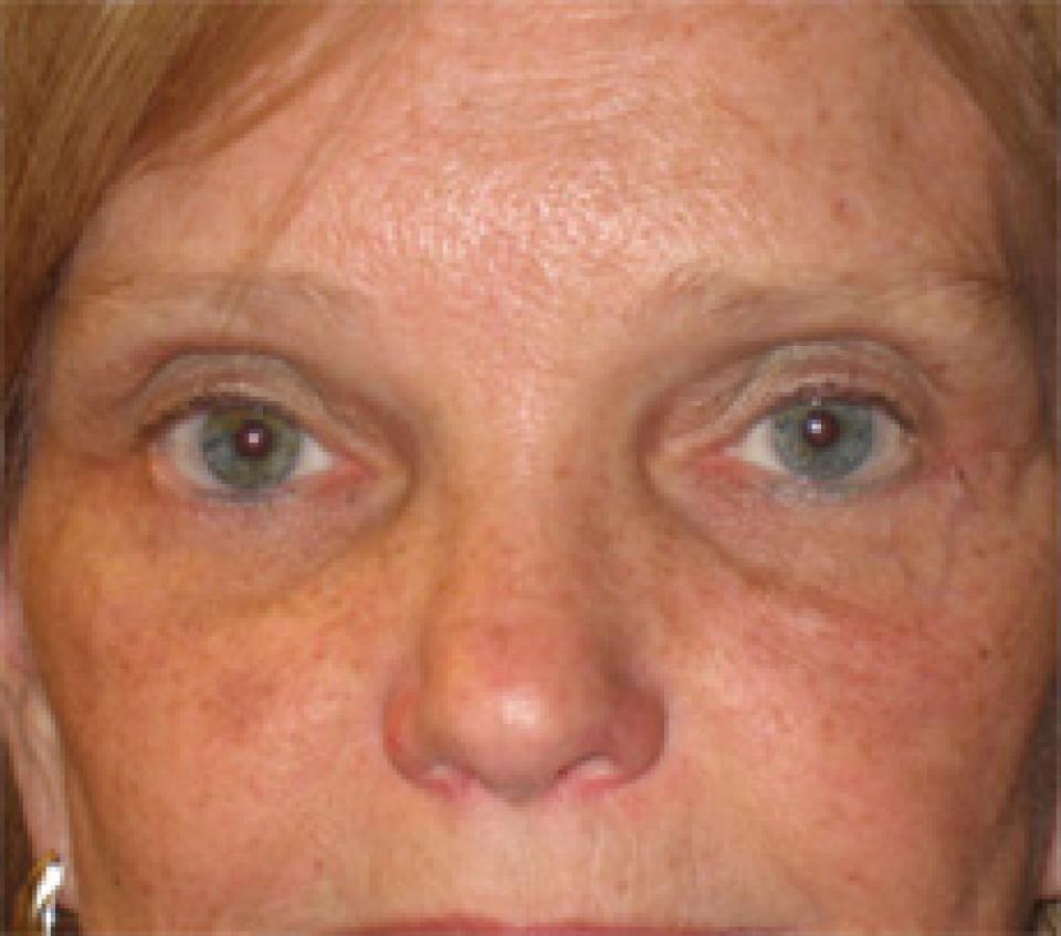 Ksenija Belsley, MD eyelid lift after — New York, NY