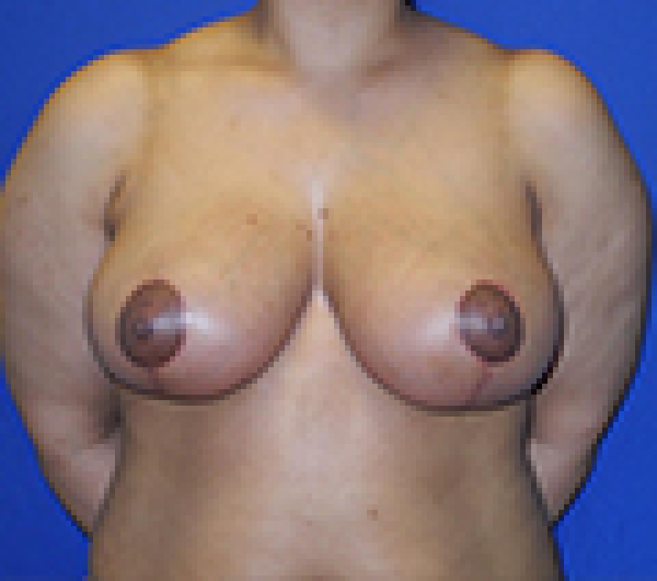 Ksenija Belsley, MD breast reduction after — New York, NY