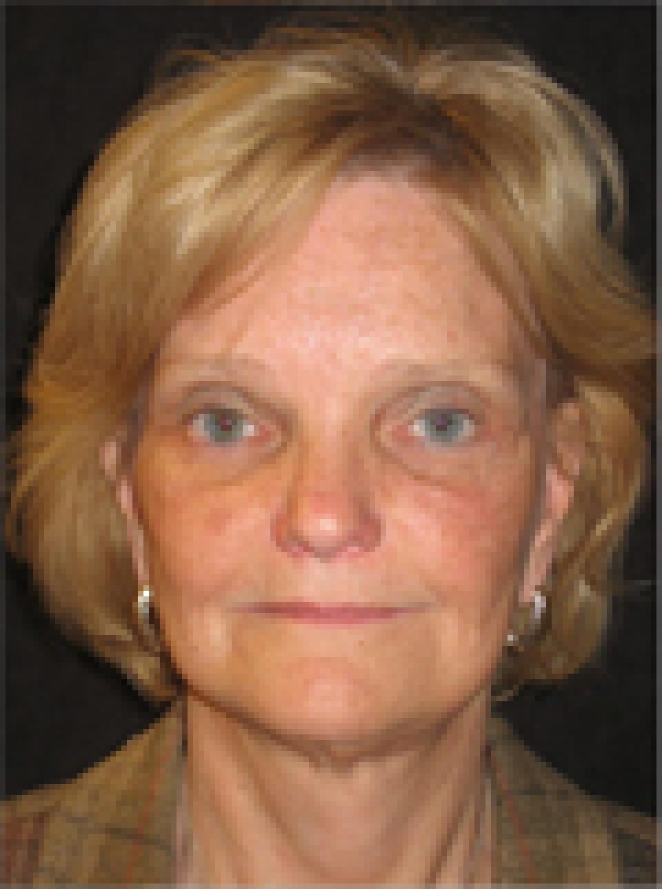 Ksenija Belsley, MD eyelid lift after — New York, NY