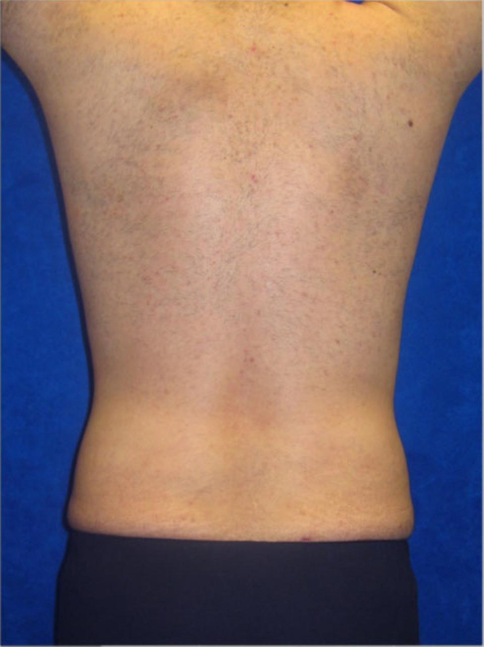 Ksenija Belsley, MD liposuction after — New York, NY