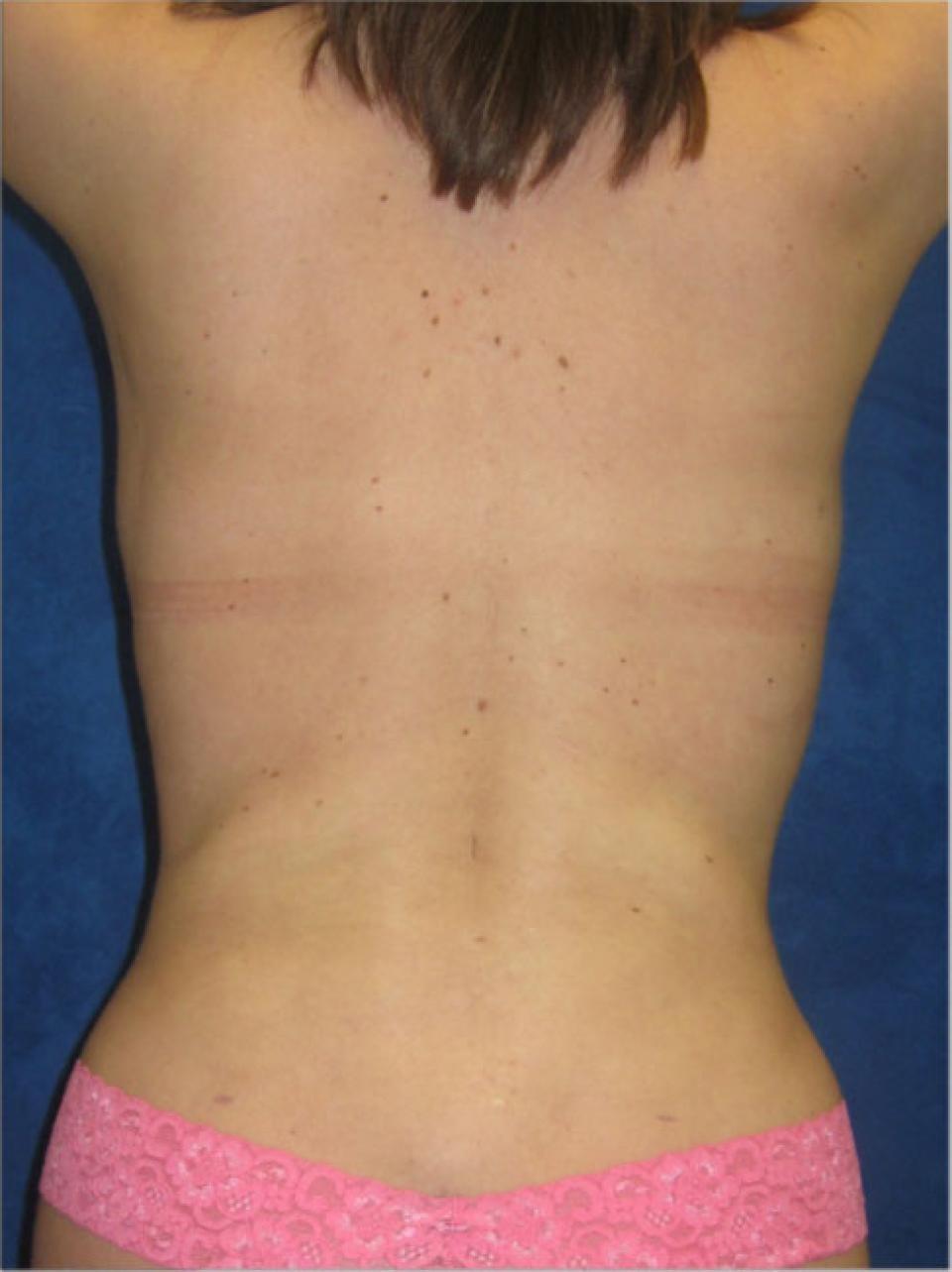 Ksenija Belsley, MD liposuction after — New York, NY
