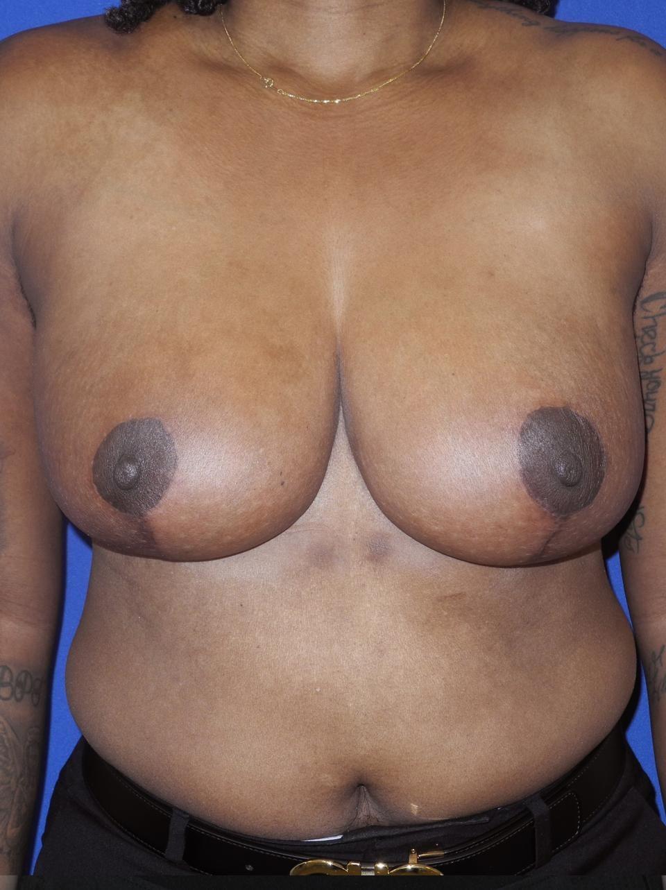 Ksenija Belsley, MD breast reduction after — New York, NY