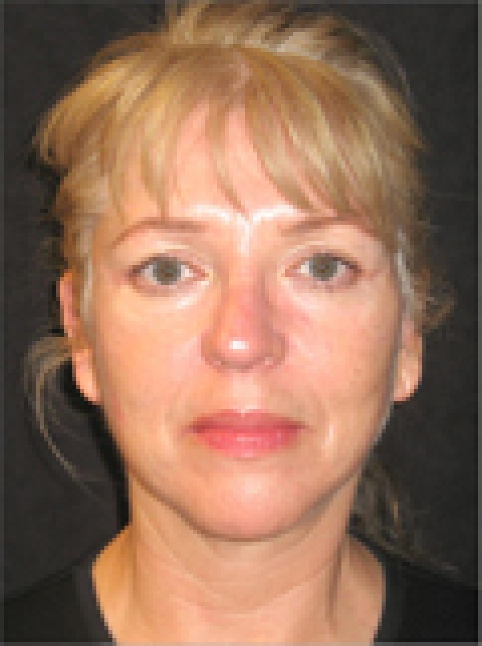 Ksenija Belsley, MD facelift after — New York, NY