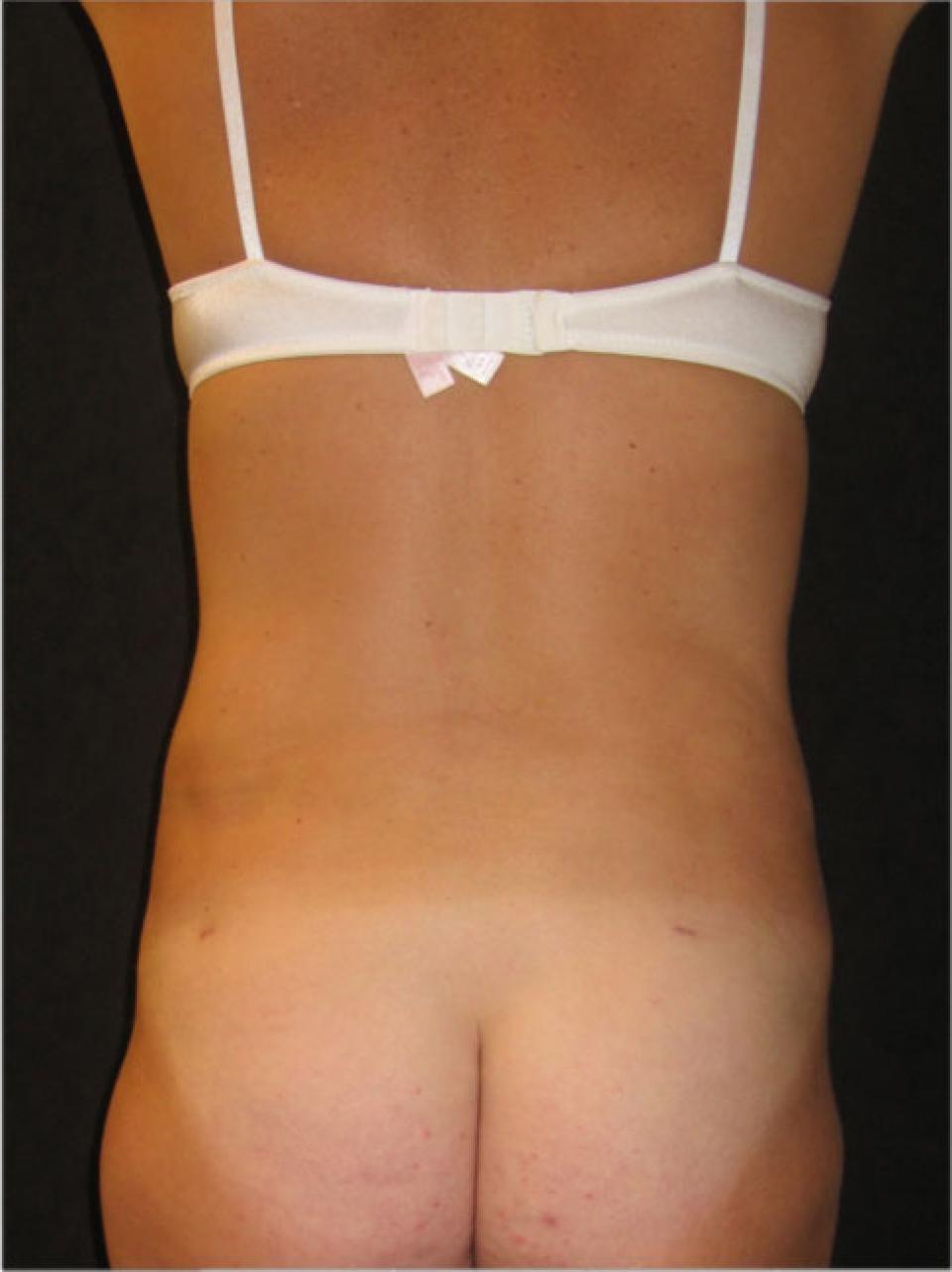 Ksenija Belsley, MD liposuction after — New York, NY