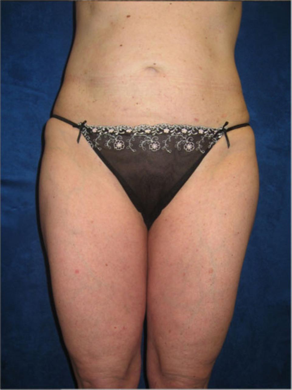 Ksenija Belsley, MD liposuction after — New York, NY