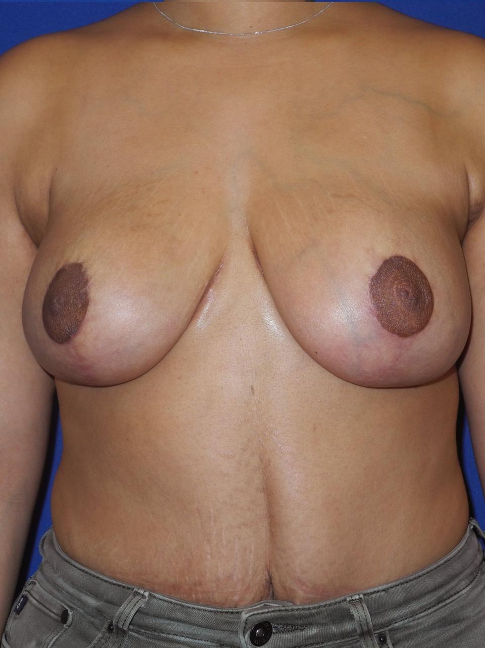 Ksenija Belsley, MD breast reduction after — New York, NY