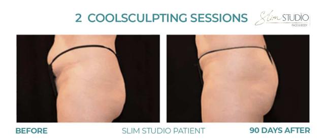 CoolSculpting result at Slim Studio FACE & BODY in Atlanta, GA