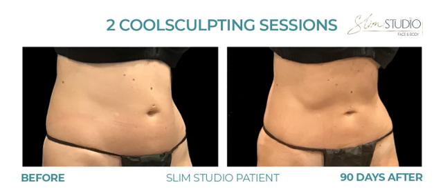 CoolSculpting result at Slim Studio FACE & BODY in Atlanta, GA