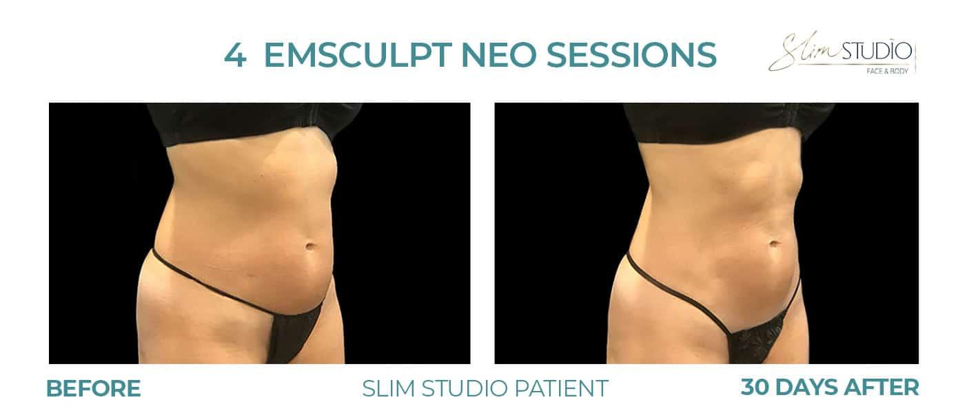 Slim Studio FACE & BODY result — Atlanta, GA