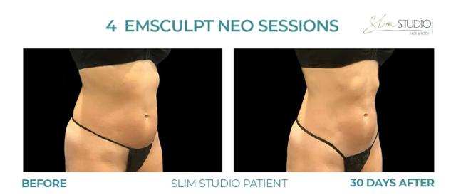 Thigh Lift result at Slim Studio FACE & BODY in Atlanta, GA