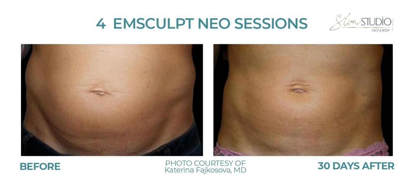 Slim Studio FACE & BODY result — Atlanta, GA