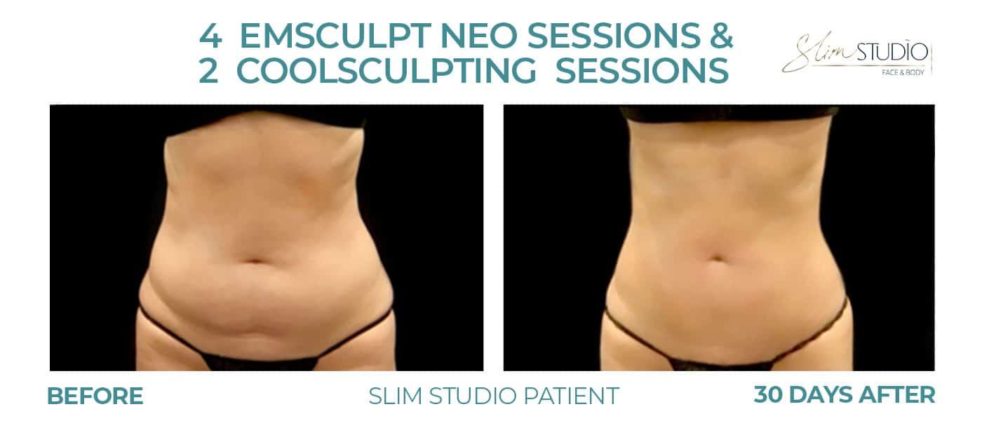 Slim Studio FACE & BODY result — Atlanta, GA