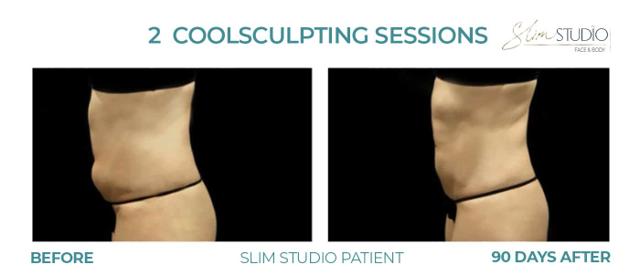 CoolSculpting result at Slim Studio FACE & BODY in Atlanta, GA