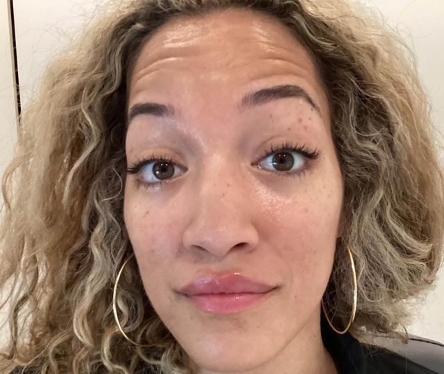 Botox before at Slim Studio FACE & BODY in Atlanta, GA