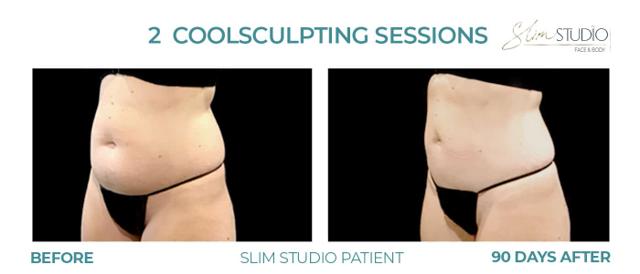 CoolSculpting result at Slim Studio FACE & BODY in Atlanta, GA