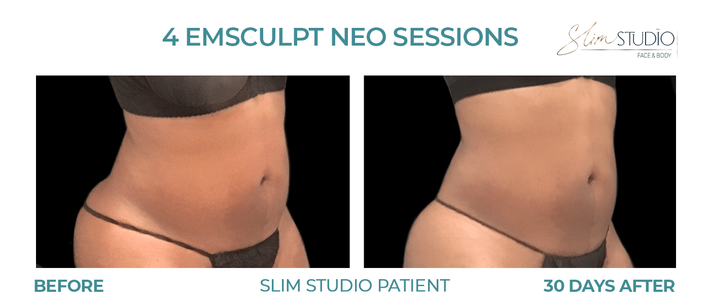 Slim Studio FACE & BODY result — Atlanta, GA