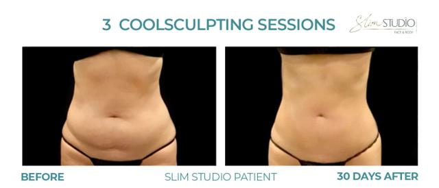 CoolSculpting result at Slim Studio FACE & BODY in Atlanta, GA