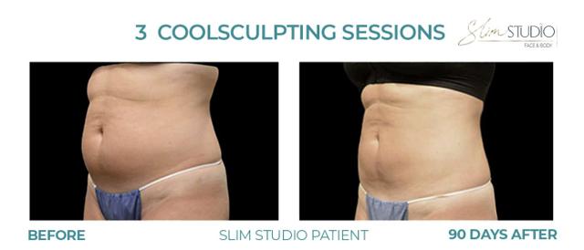 CoolSculpting result at Slim Studio FACE & BODY in Atlanta, GA