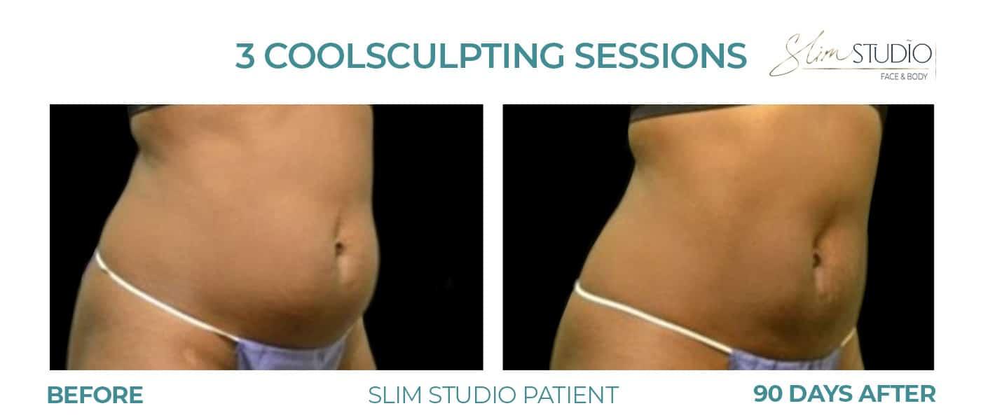 Slim Studio FACE & BODY result — Atlanta, GA