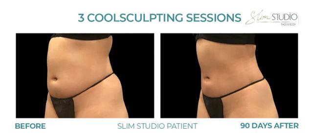CoolSculpting result at Slim Studio FACE & BODY in Atlanta, GA