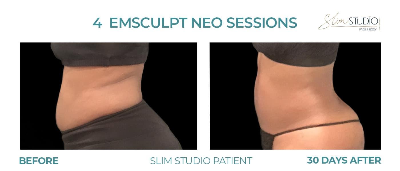 Slim Studio FACE & BODY result — Atlanta, GA