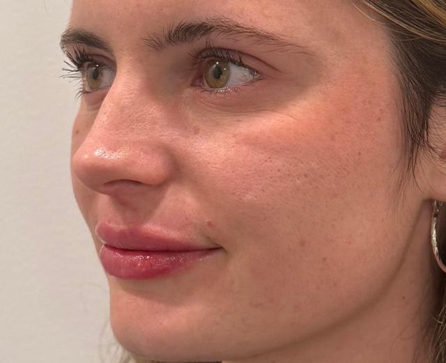 Lip Filler after at Slim Studio FACE & BODY in Atlanta, GA