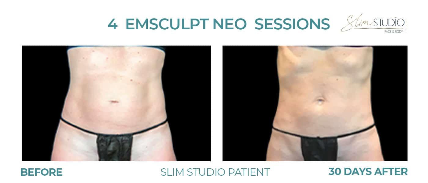 Slim Studio FACE & BODY result — Atlanta, GA