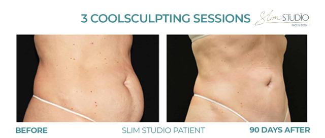 CoolSculpting result at Slim Studio FACE & BODY in Atlanta, GA