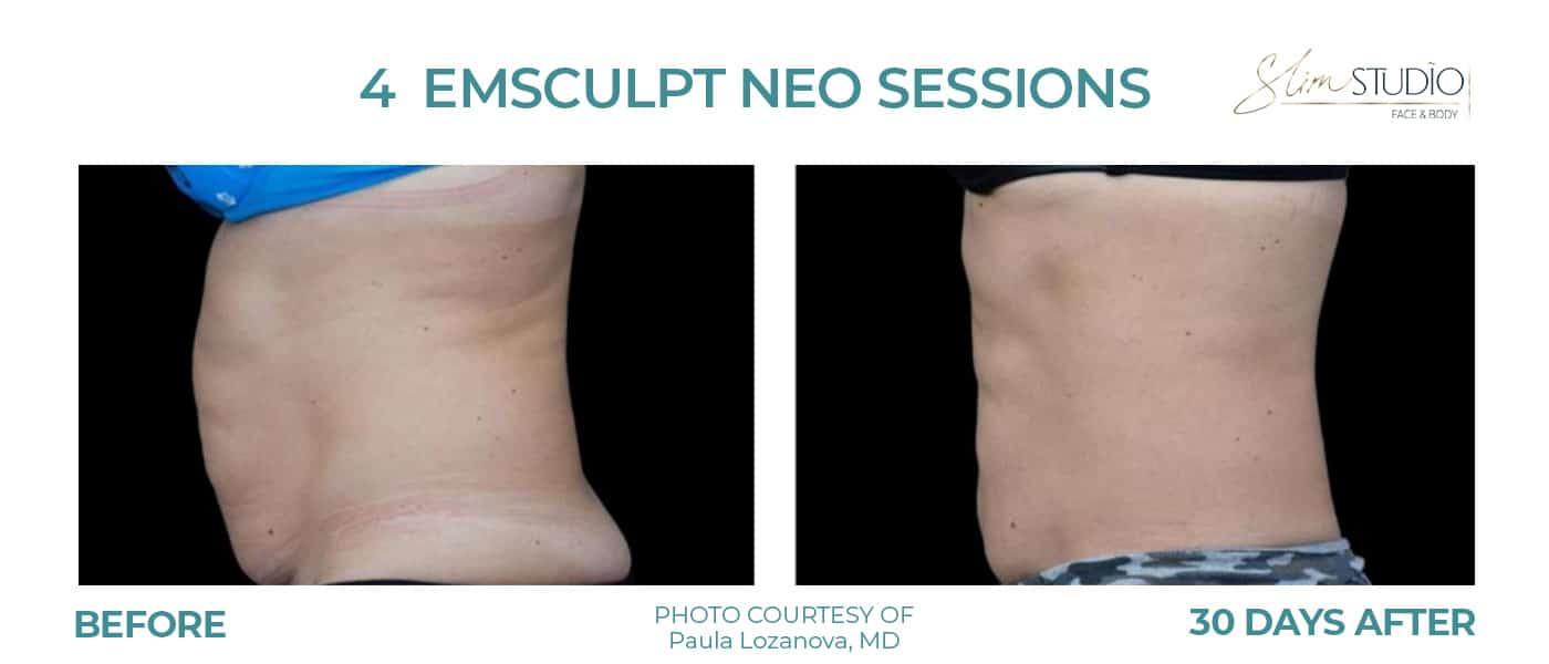 Slim Studio FACE & BODY result — Atlanta, GA