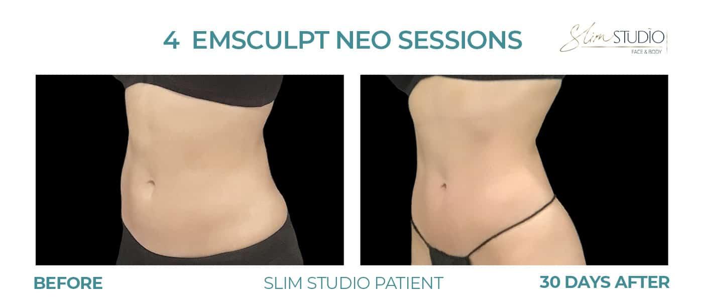 Slim Studio FACE & BODY result — Atlanta, GA